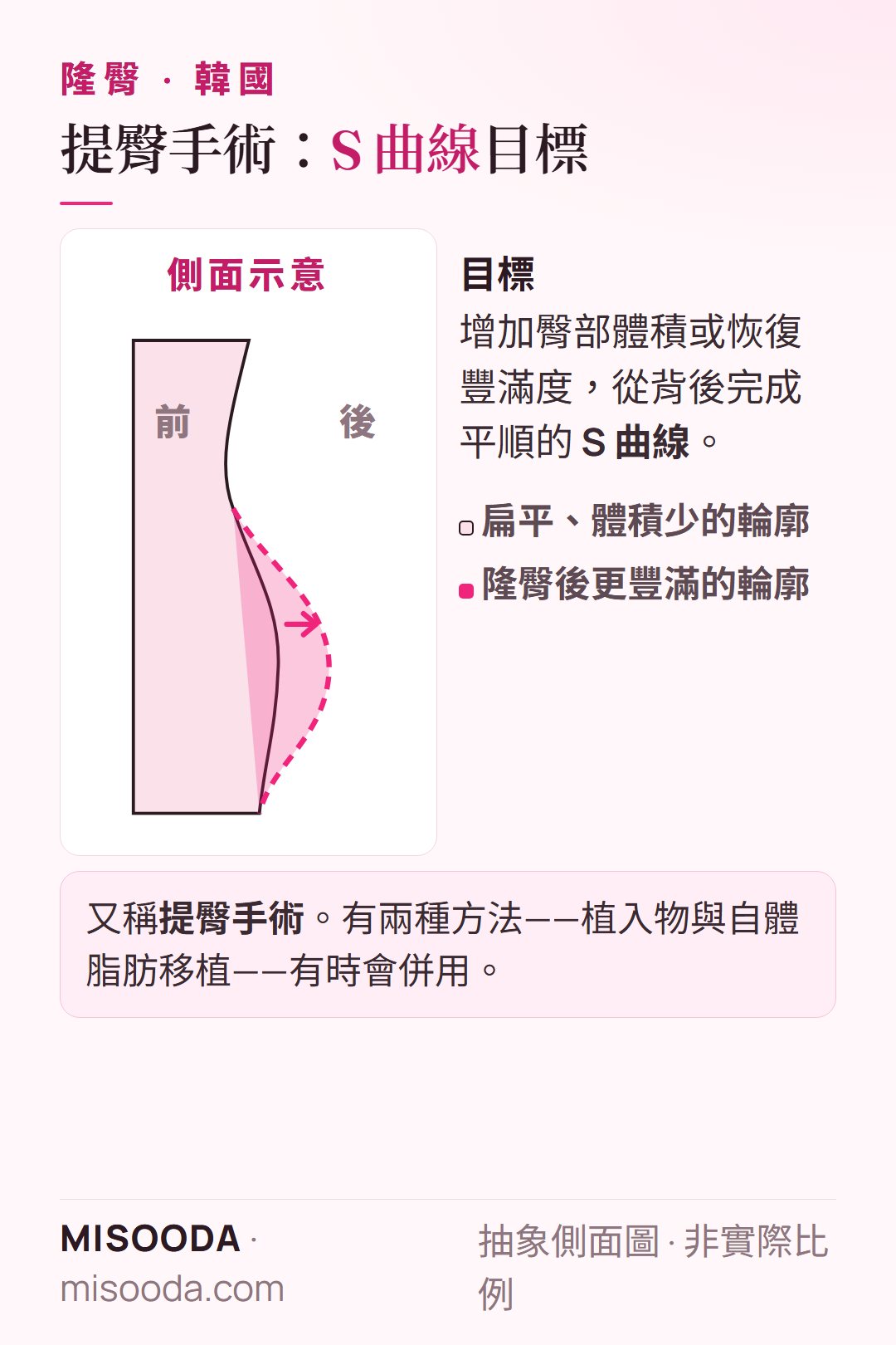 韓國 隆臀(提臀手術)目標抽象側面圖:讓扁平的臀部輪廓更豐滿,從背後完成 S 曲線