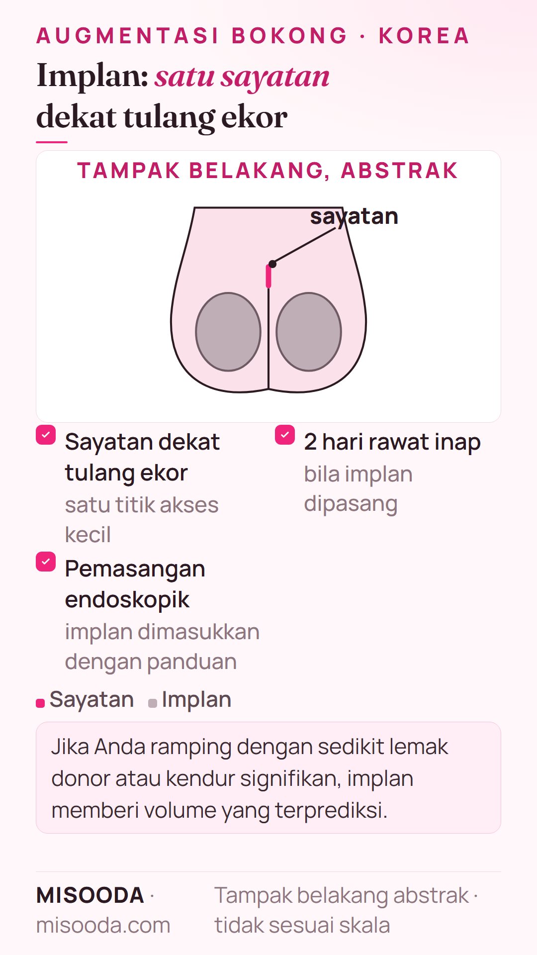 Pemasangan implan bokong dalam tampak belakang abstrak: sayatan dekat tulang ekor dan pemasangan implan endoskopik, 2 hari rawat inap