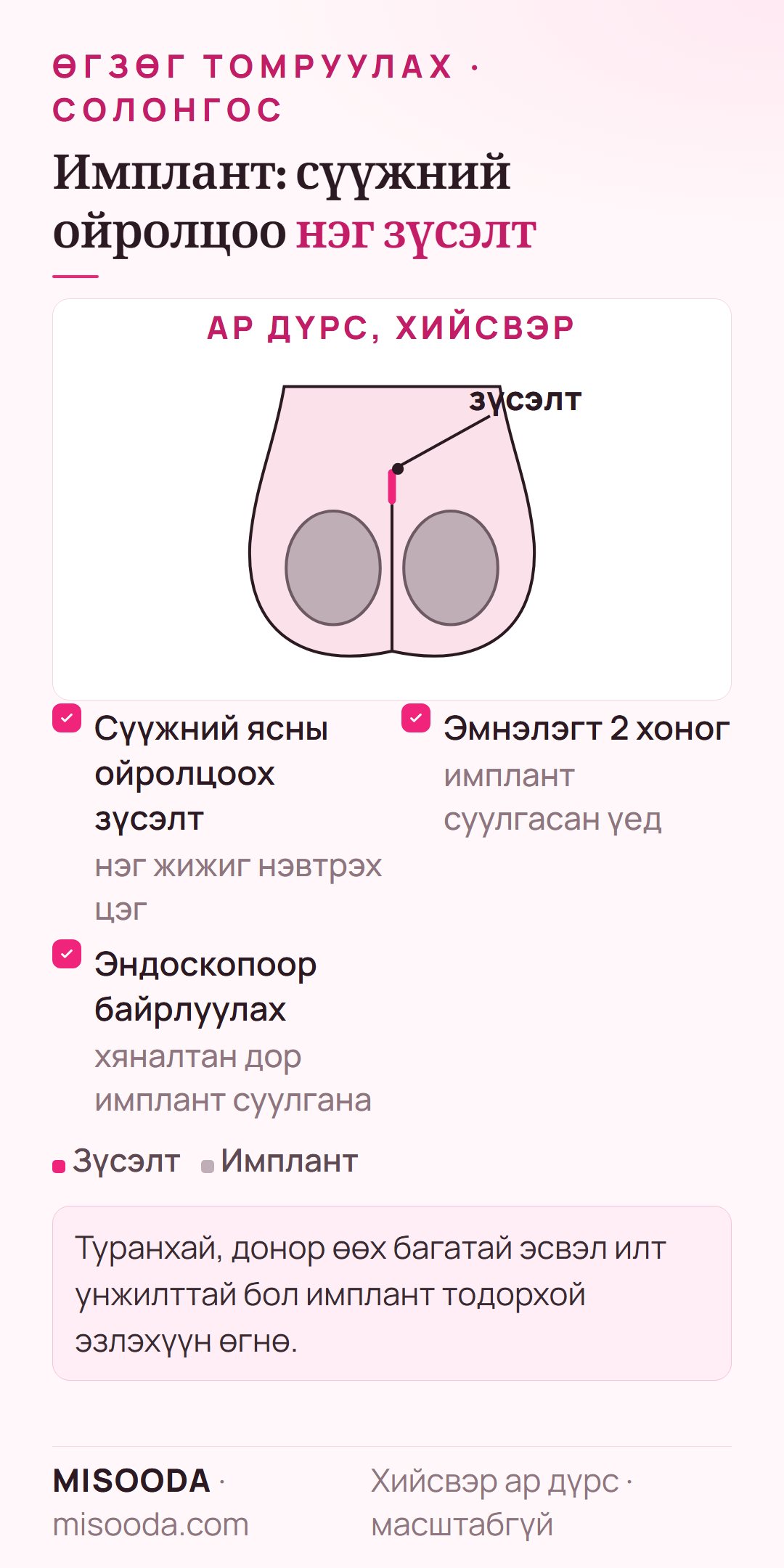 Өгзөгний имплант суулгах нь хийсвэр ар дүрсээр: сүүжний ойролцоох зүсэлт, эндоскопоор имплант байрлуулах, эмнэлэгт 2 хоног