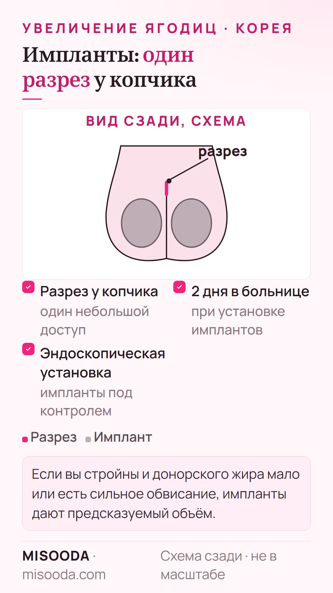 Установка импланта ягодиц на схеме сзади: разрез у копчика и эндоскопическая установка, 2 дня в больнице