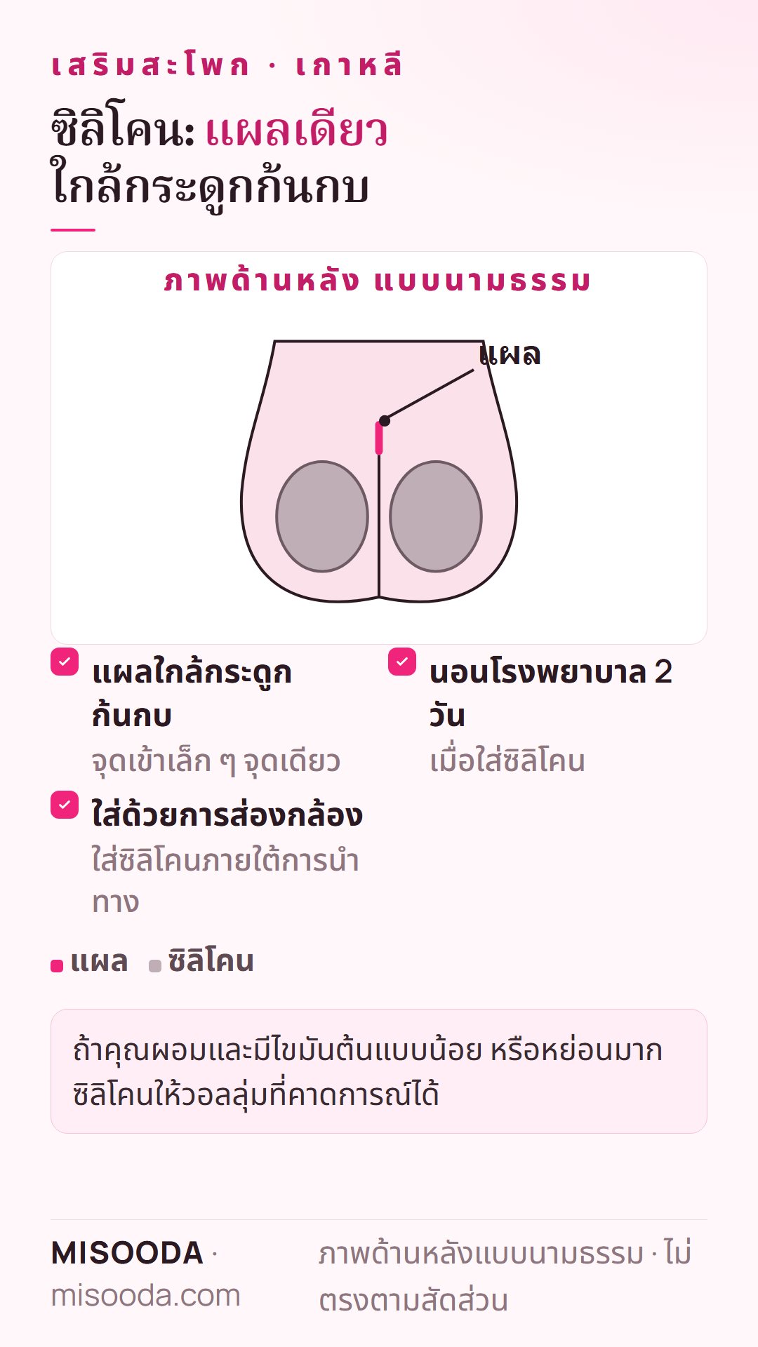 ใส่ซิลิโคนสะโพก แสดงเป็นภาพด้านหลังแบบนามธรรม: แผลใกล้กระดูกก้นกบ ใส่ซิลิโคนด้วยการส่องกล้อง นอนโรงพยาบาล 2 วัน