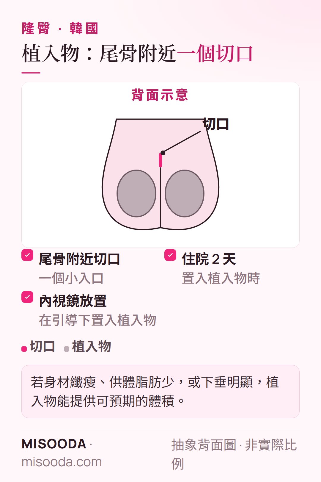 韓國 隆臀植入物抽象背面圖:在尾骨附近做一個切口,以內視鏡置入臀部植入物,術後住院 2 天