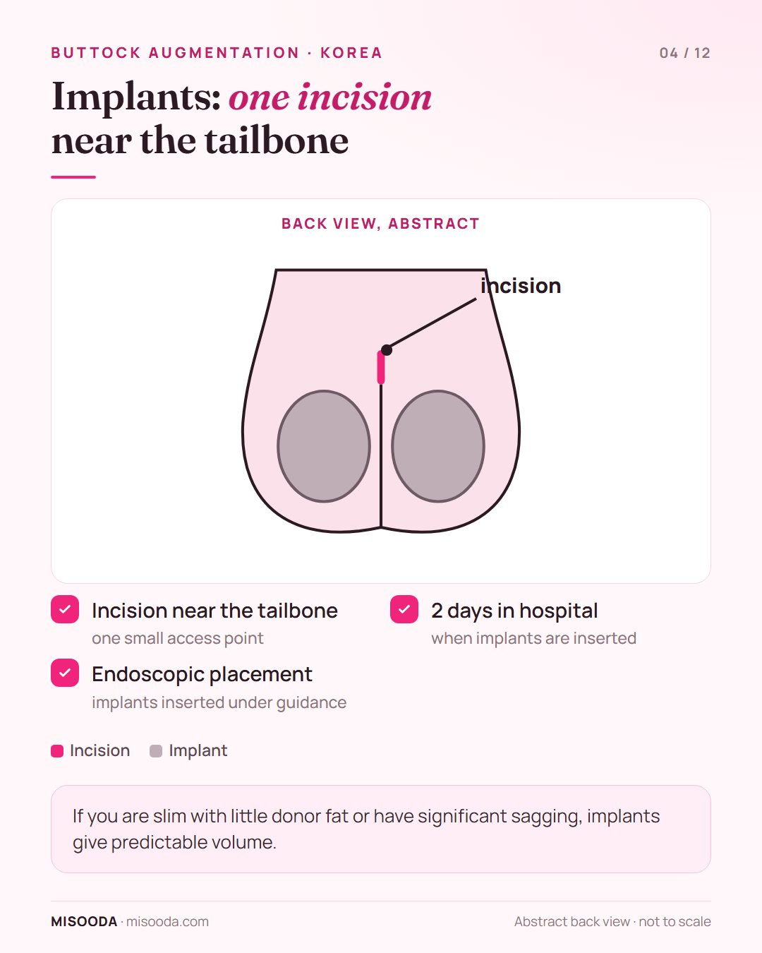 Buttock implant insertion shown as an abstract back view: an incision near the tailbone and endoscopic implant placement, 2 days in hospital