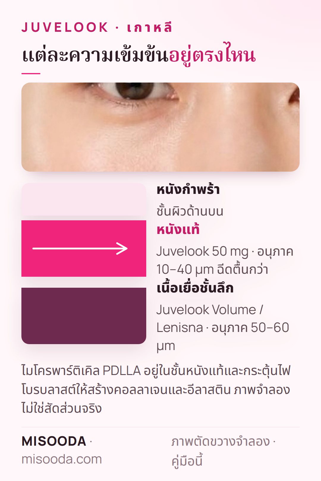 ความลึกการฉีด Juvelook เกาหลี: 50 mg อนุภาค PDLLA 10–40 µm ฉีดตื้นในชั้นหนังแท้ ส่วน Volume หรือ Lenisna อนุภาค 50–60 µm ฉีดลึกกว่า
