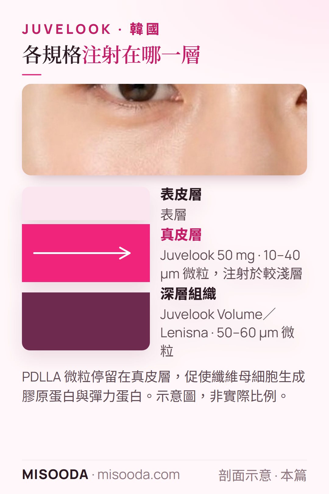 韓國 Juvelook 注射深度:50 mg 以 10–40 µm PDLLA 微粒注射於真皮較淺層;Volume 或 Lenisna 以 50–60 µm 微粒注射於較深層