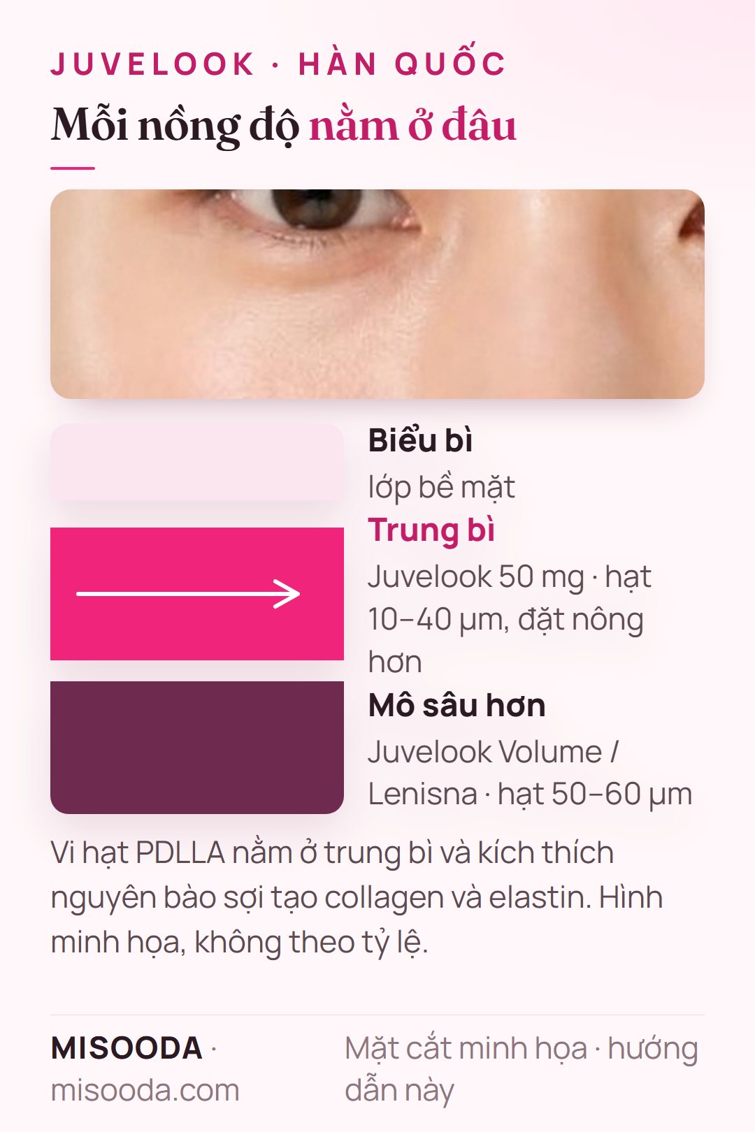 Độ sâu tiêm Juvelook tại Hàn Quốc: 50 mg với hạt PDLLA 10–40 µm đặt nông trong trung bì; Volume hoặc Lenisna với hạt 50–60 µm đặt sâu hơn