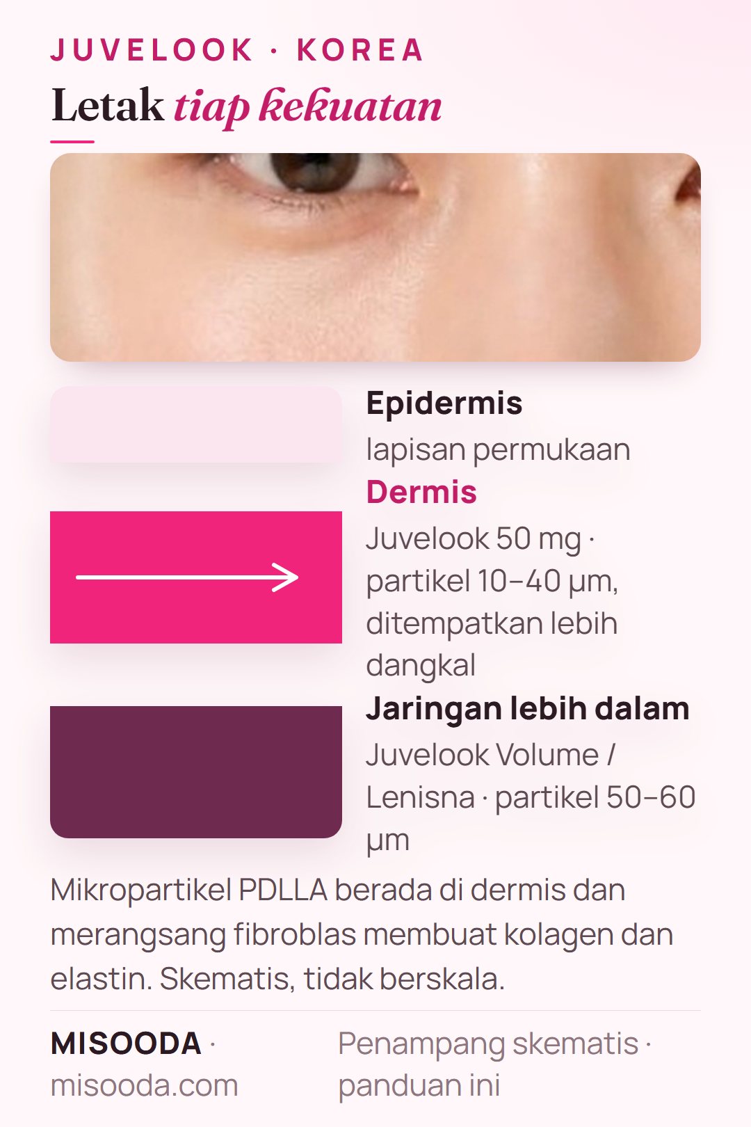 Kedalaman suntikan Juvelook: 50 mg dengan partikel PDLLA 10–40 µm ditempatkan dangkal di dermis; Volume atau Lenisna dengan partikel 50–60 µm ditempatkan lebih dalam