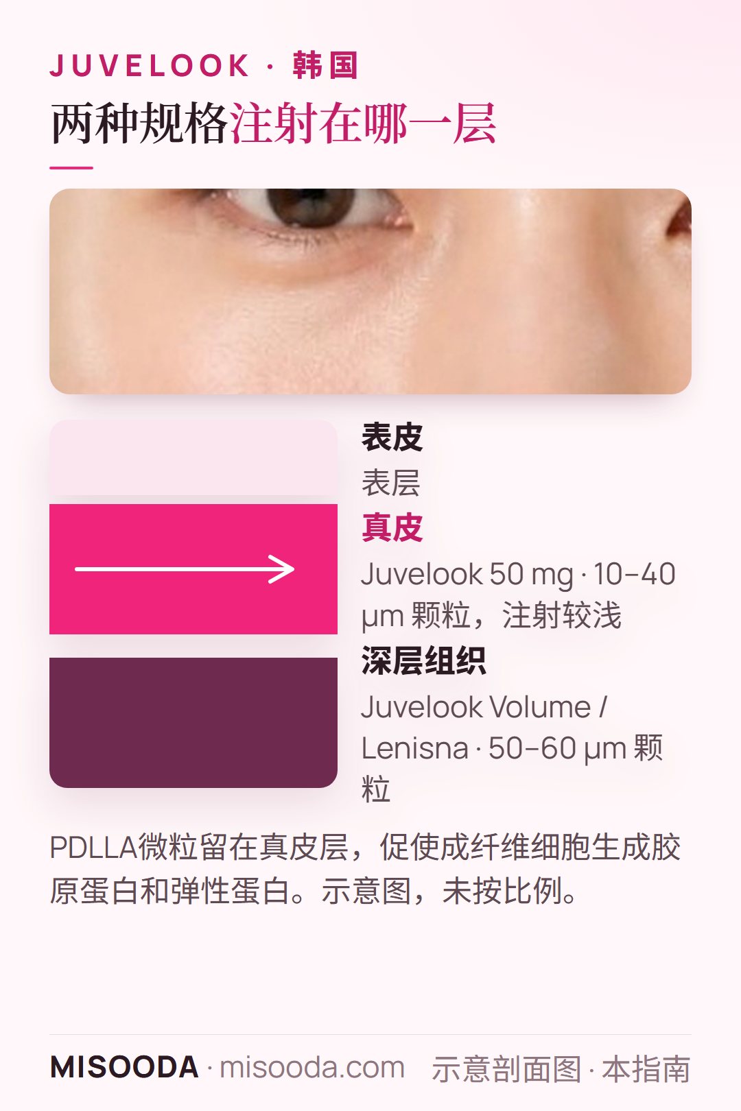 韩国 Juvelook 注射深度:50 mg 的 10–40 µm PDLLA 颗粒注射在真皮较浅处;Volume 或 Lenisna 的 50–60 µm 颗粒注射更深