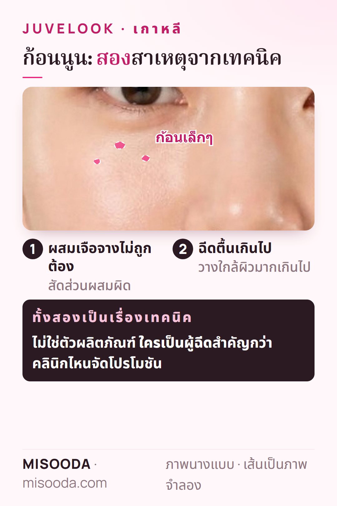 ทำไมจึงเกิดก้อนนูนหลัง Juvelook PDLLA เกาหลี: ผสมเจือจางไม่ถูกต้องหรือฉีดตื้นเกินไป — ทั้งสองเป็นปัญหาเทคนิค ไม่ใช่ความผิดของผลิตภัณฑ์