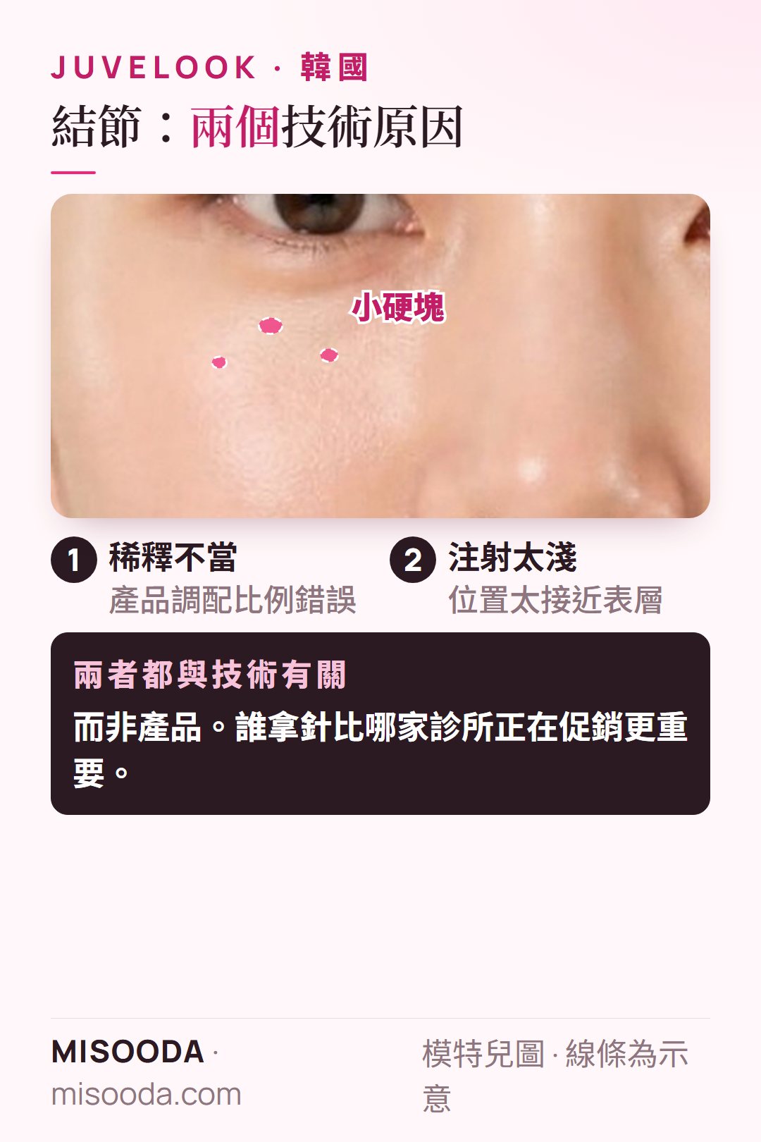 韓國 Juvelook PDLLA 結節成因:產品稀釋不當或注射太淺——兩者都是技術問題,而非產品缺陷