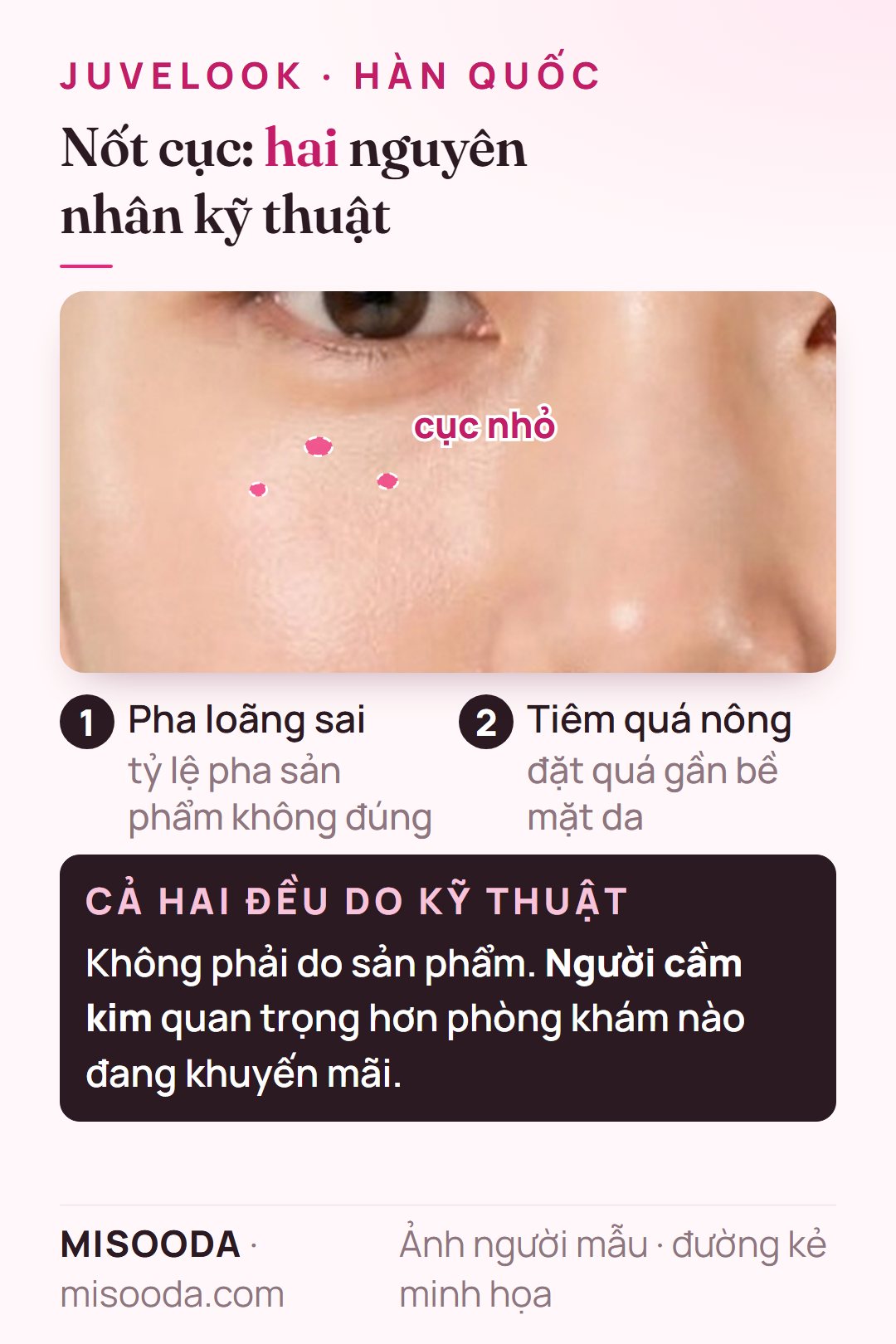 Vì sao nổi nốt cục sau tiêm Juvelook PDLLA: sản phẩm pha loãng sai hoặc tiêm quá nông — cả hai đều do kỹ thuật, không phải lỗi sản phẩm