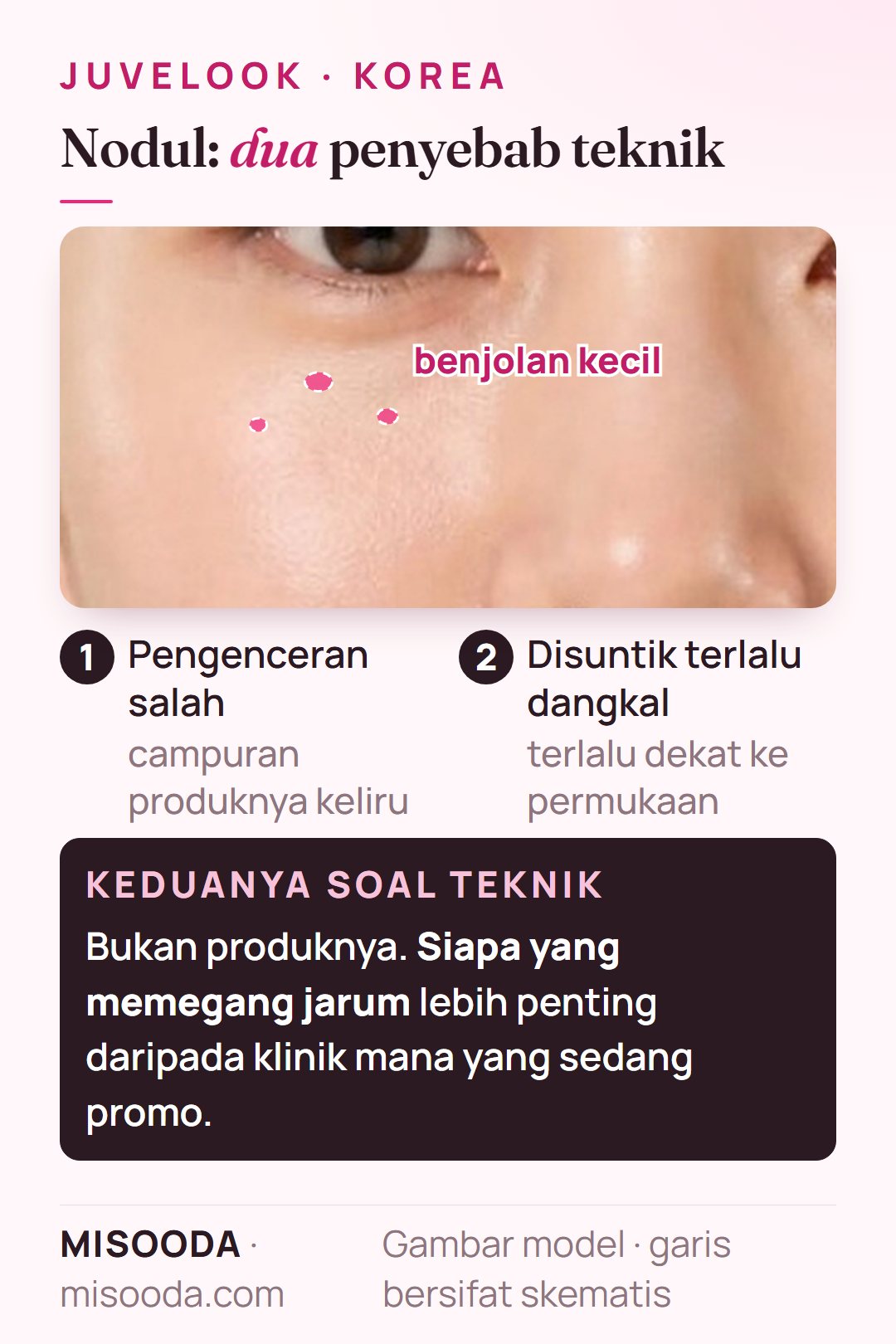 Mengapa nodul Juvelook PDLLA terjadi: produk diencerkan dengan salah atau disuntik terlalu dangkal — keduanya masalah teknik, bukan cacat produk