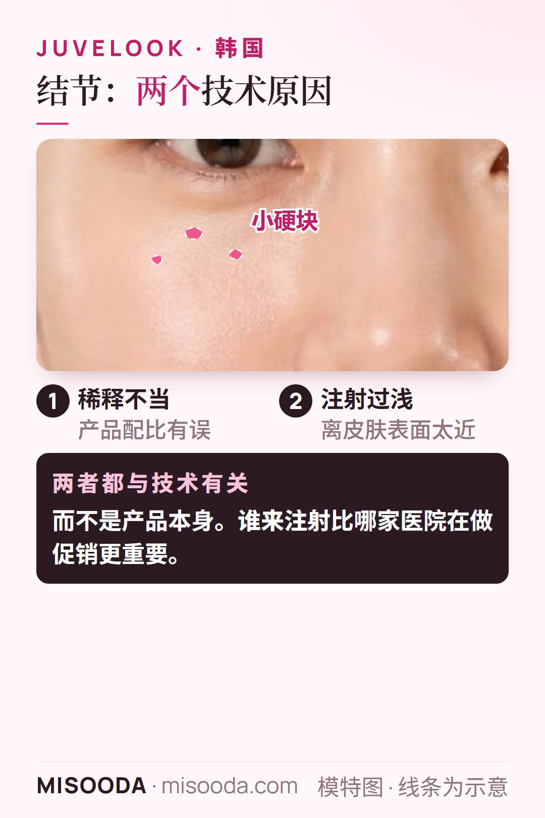 韩国 Juvelook PDLLA 结节成因:产品稀释不当或注射过浅——都是技术问题,而非产品缺陷