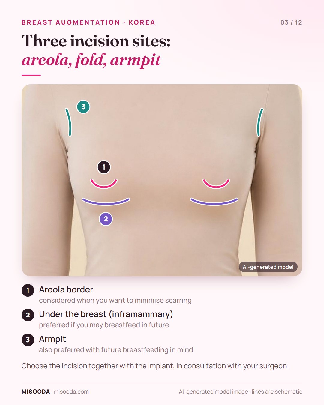 Breast augmentation incision sites marked on a clothed model: areola border, inframammary fold under the breast, and armpit