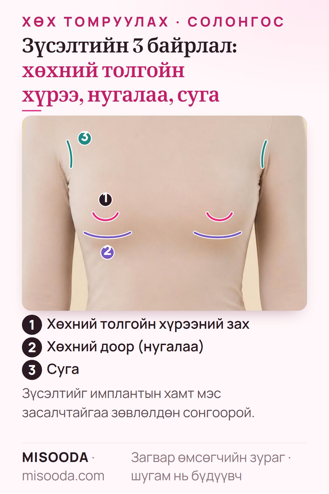 Хувцастай загвар дээр тэмдэглэсэн хөх томруулах зүсэлтийн байрлал: хөхний толгойн хүрээний зах, хөхний доорх нугалаа, суга