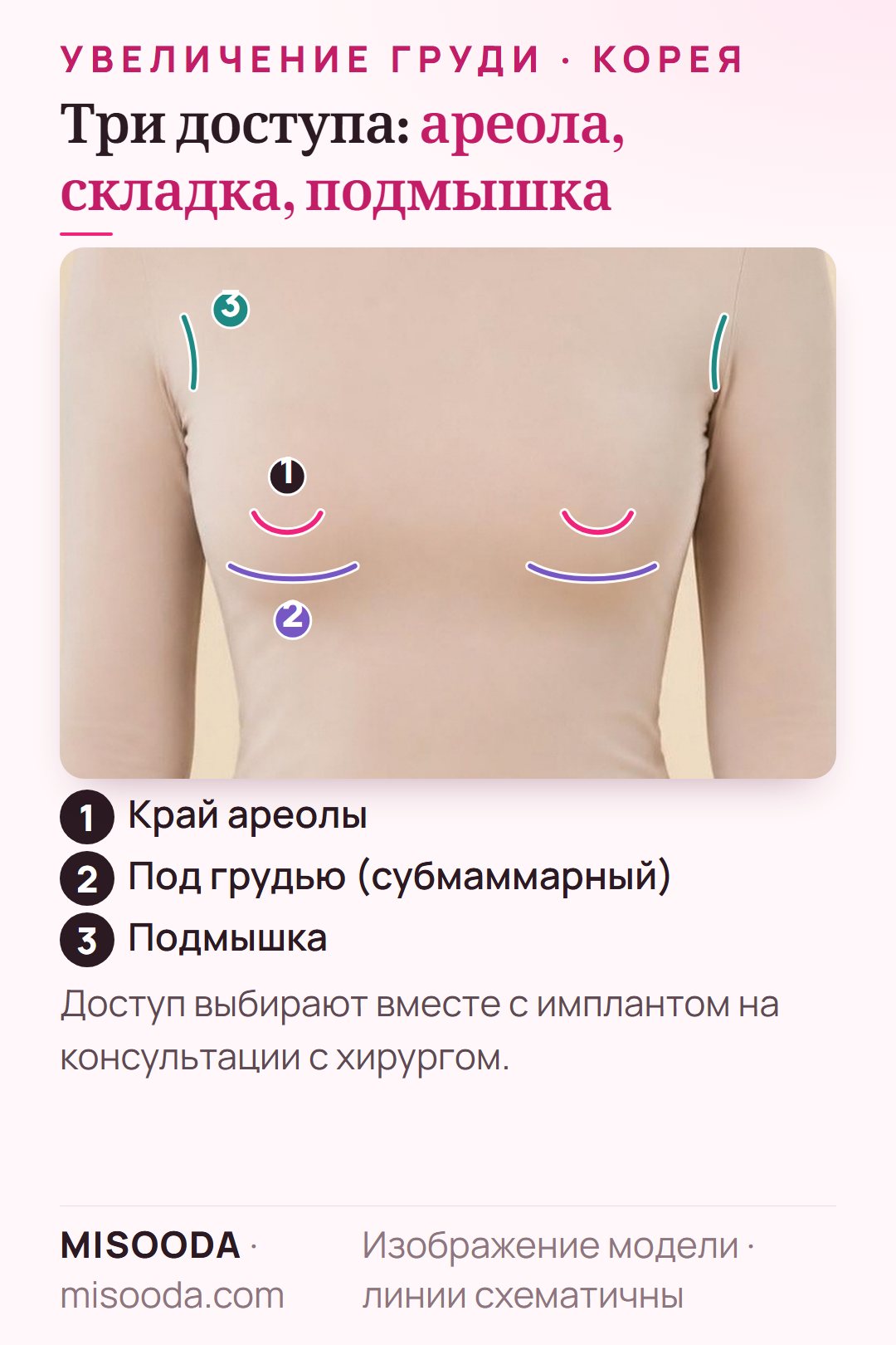 Доступы при увеличении груди на одетой модели: край ареолы, субмаммарная складка под грудью и подмышка