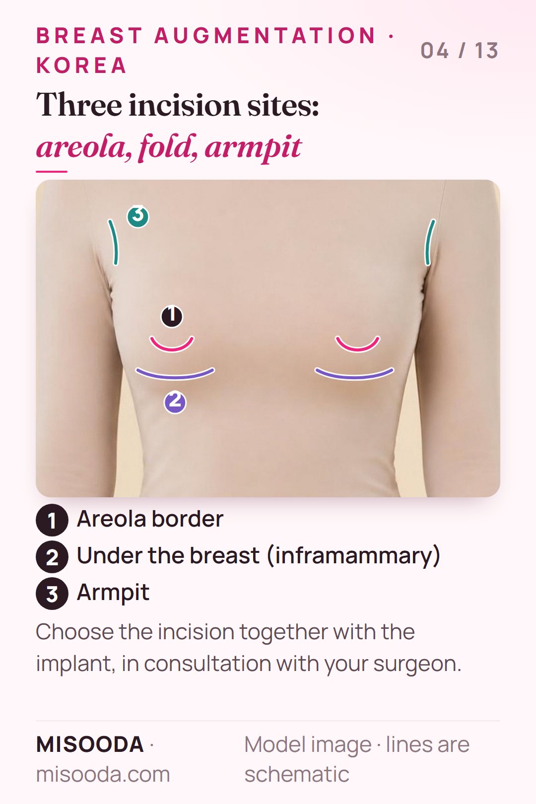 Breast augmentation incision sites marked on a clothed model: areola border, inframammary fold under the breast, and armpit