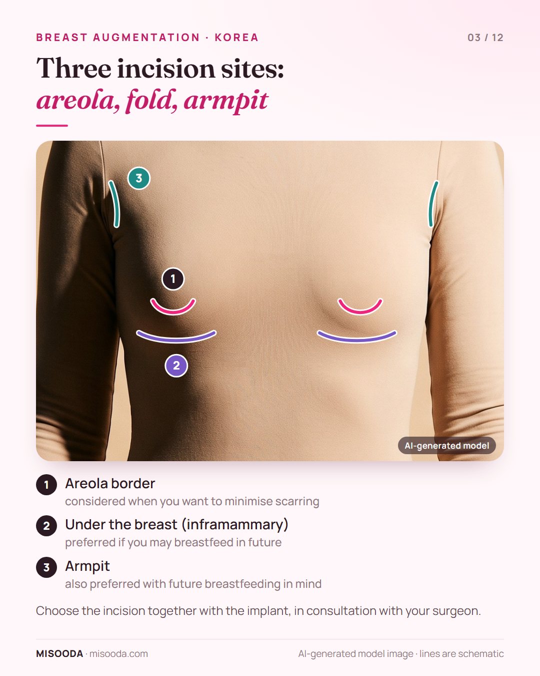 Breast augmentation incision sites marked on a clothed model: areola border, inframammary fold under the breast, and armpit