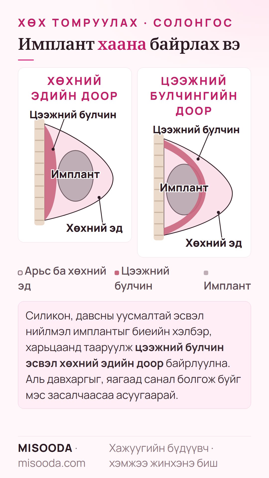Солонгост хөх томруулах имплантын байрлал: хөхний эдийн доор ба цээжний булчингийн доорх имплантын хажуугийн бүдүүвч