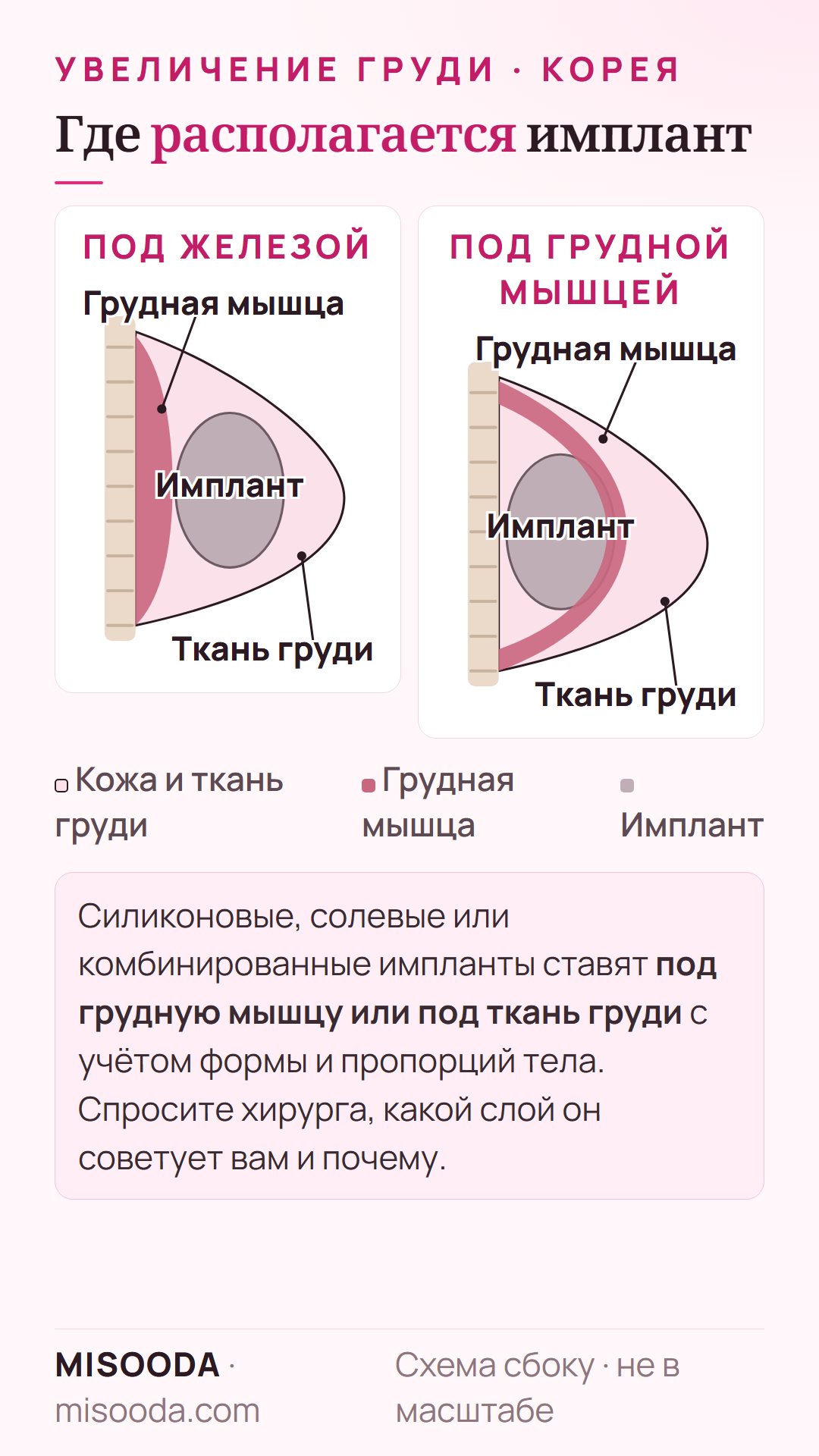 Положение импланта при увеличении груди в Корее: схема сбоку — имплант под тканью груди или под грудной мышцей