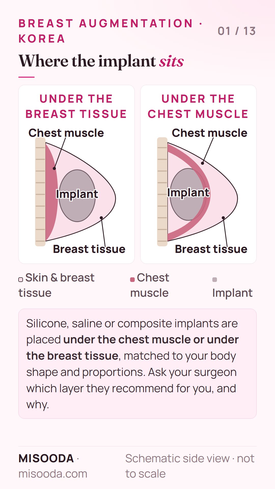 Breast implant placement in Korea: schematic side view of an implant under the breast tissue versus under the chest muscle