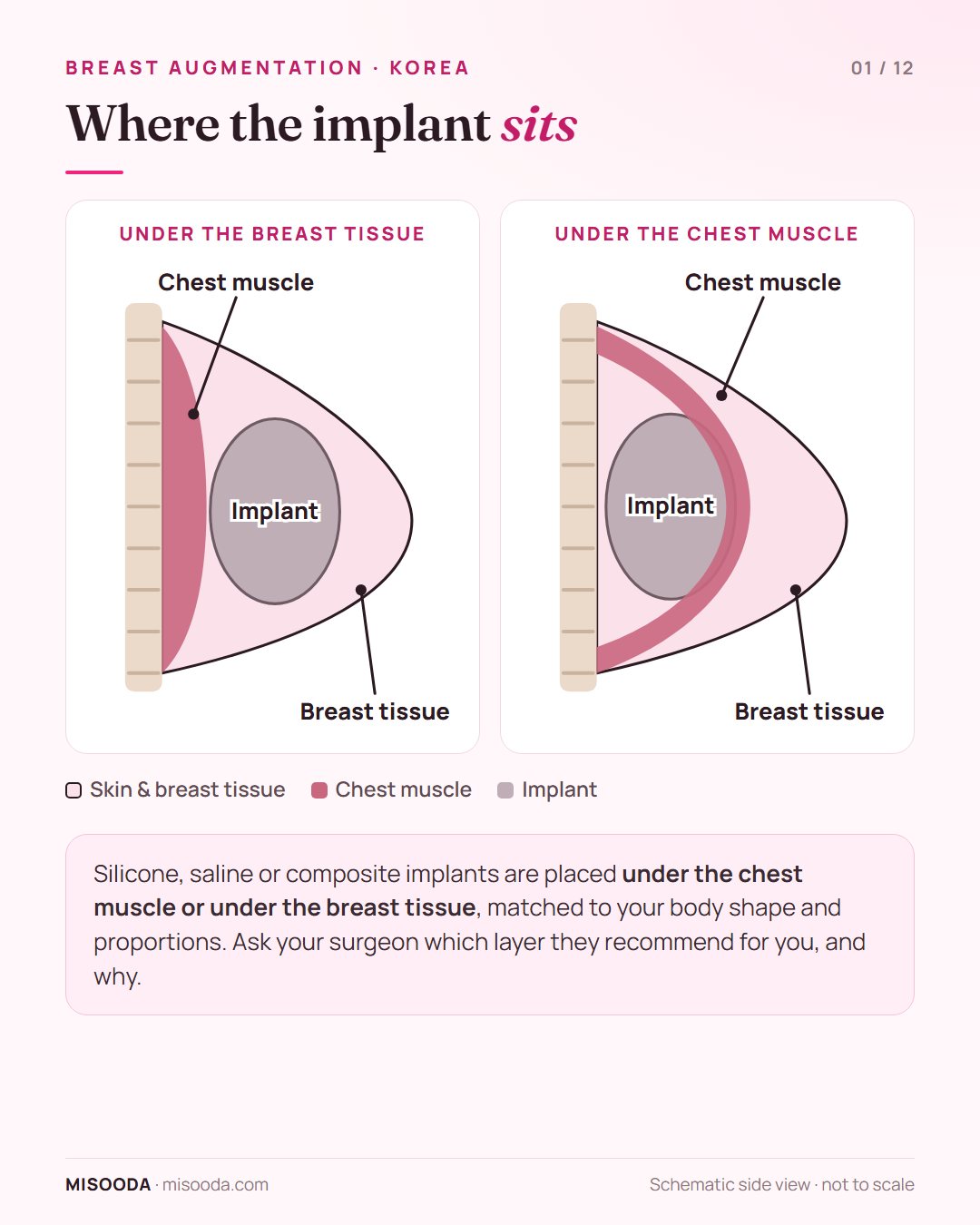 Breast implant placement in Korea: schematic side view of an implant under the breast tissue versus under the chest muscle