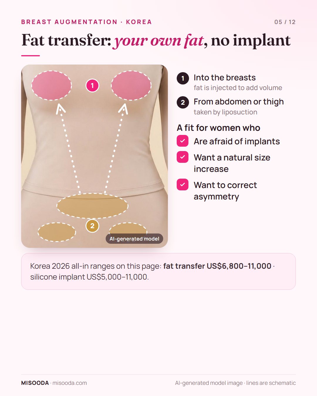 Fat transfer breast augmentation: fat taken from abdomen or thigh by liposuction and injected into the breasts, about US$6,800–11,000 in Korea