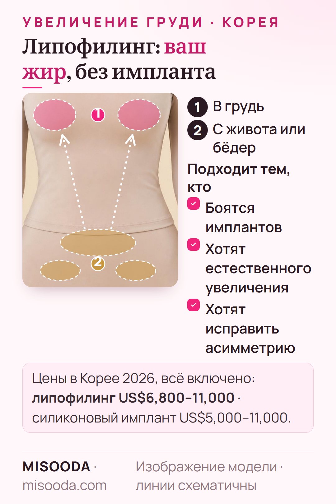 Увеличение груди липофилингом: жир берут липосакцией с живота или бёдер и вводят в грудь, около US$6,800–11,000 в Корее