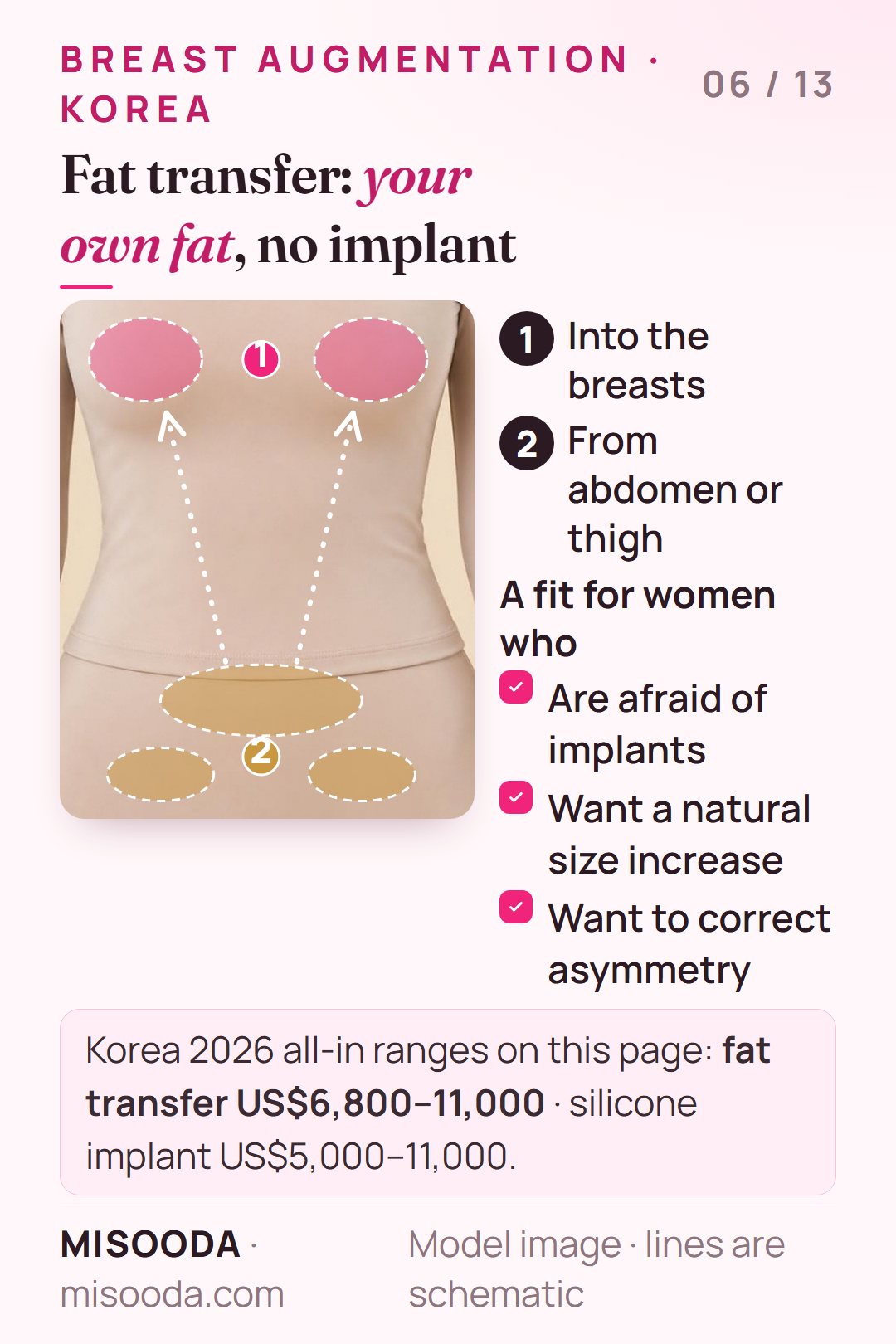 Fat transfer breast augmentation: fat taken from abdomen or thigh by liposuction and injected into the breasts, about US$6,800–11,000 in Korea