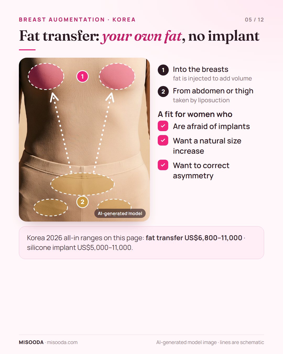 Fat transfer breast augmentation: fat taken from abdomen or thigh by liposuction and injected into the breasts, about US$6,800–11,000 in Korea