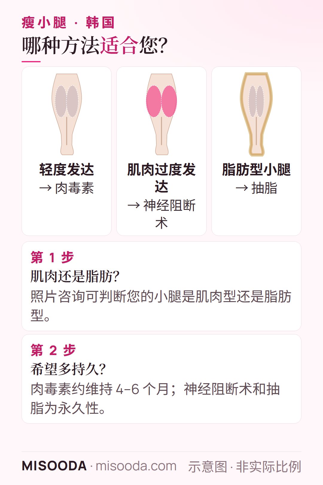 韩国 瘦小腿方法怎么选:判断小腿是肌肉型还是脂肪型,以及希望效果多持久——肉毒素、神经阻断术或抽脂