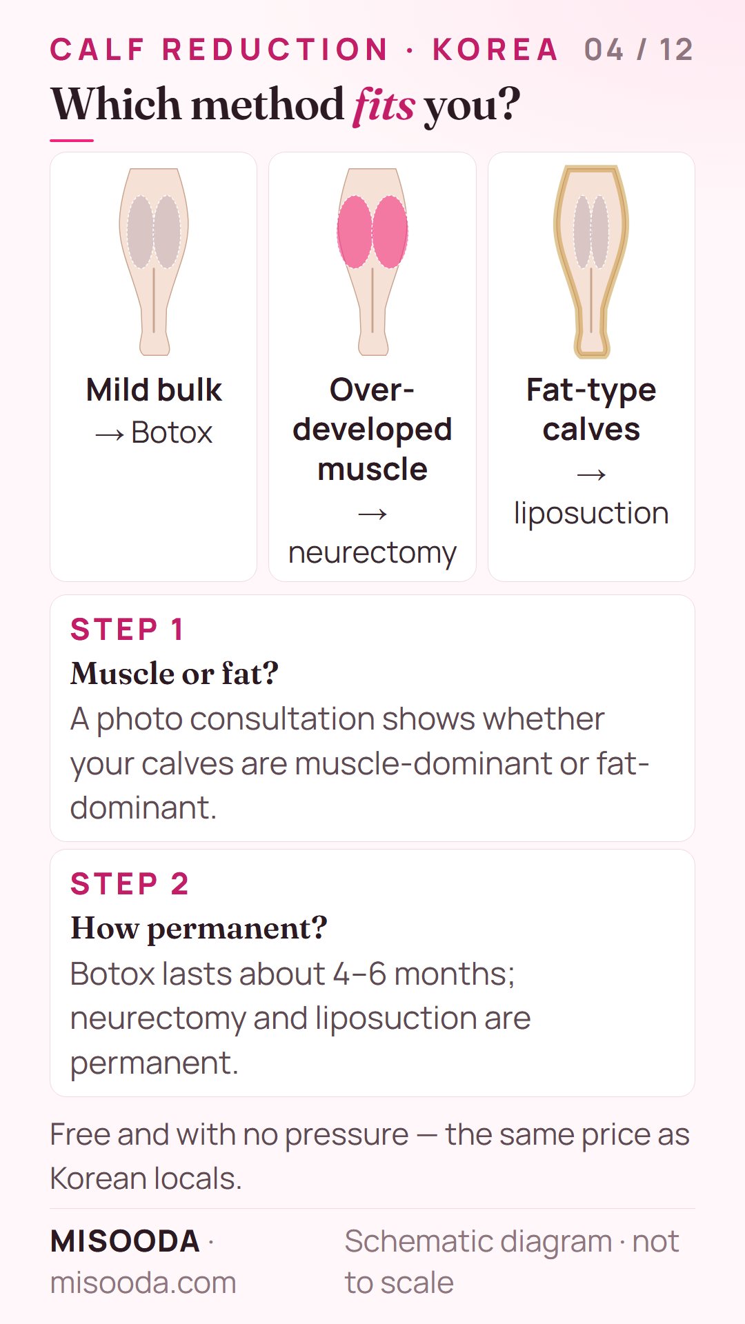 How to choose a calf reduction method: muscle-dominant or fat-dominant calves, and how permanent you want the result — Botox, neurectomy or liposuction