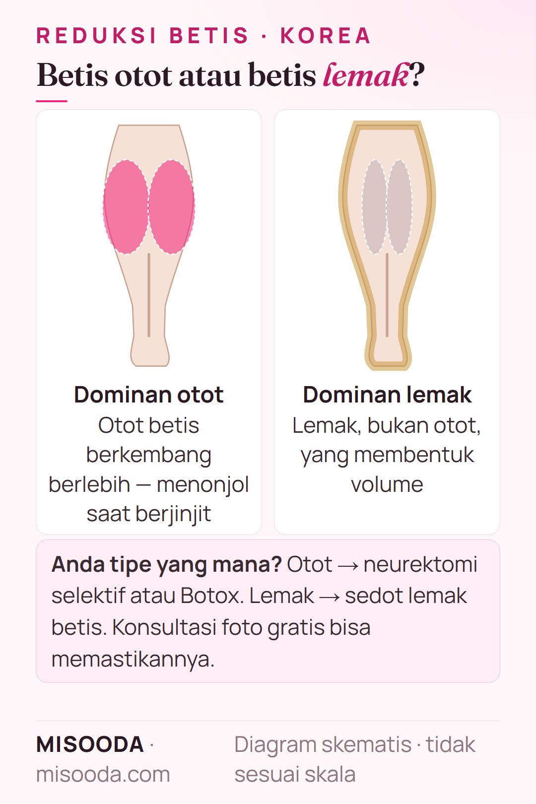 Reduksi betis di Korea: betis dominan otot vs dominan lemak dari belakang — neurektomi atau Botox untuk otot, sedot lemak betis untuk lemak