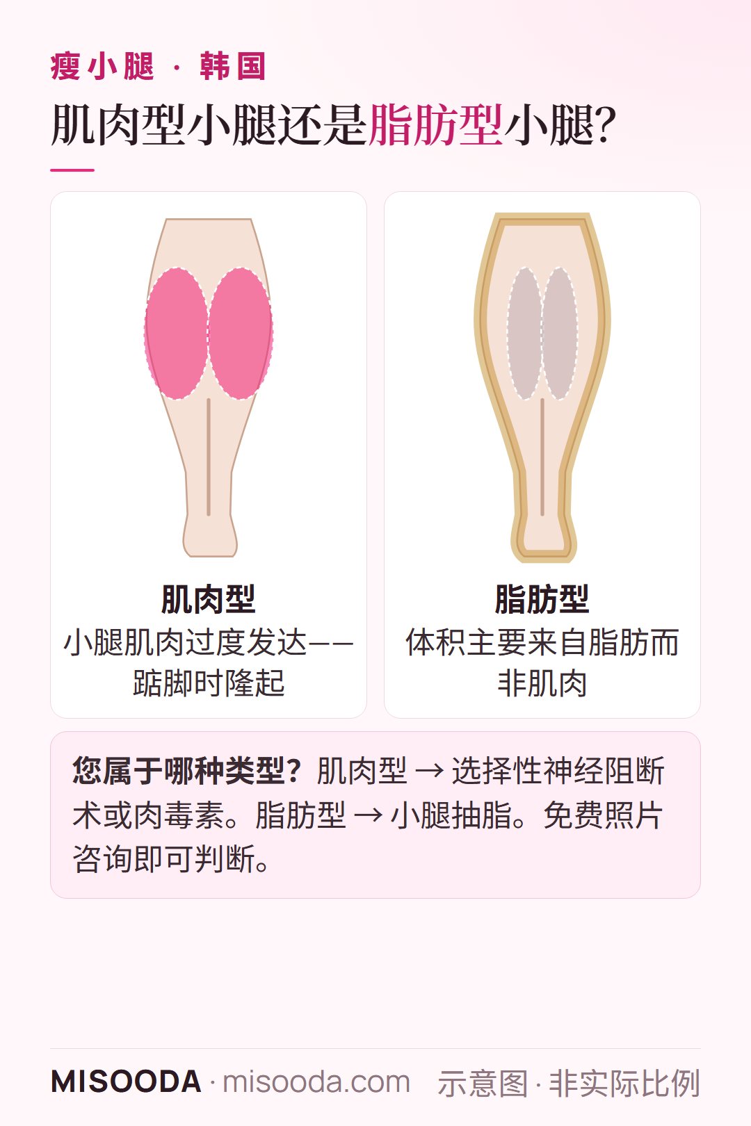 韩国 瘦小腿:从背面对比肌肉型与脂肪型小腿——肌肉型选神经阻断术或肉毒素,脂肪型选小腿抽脂