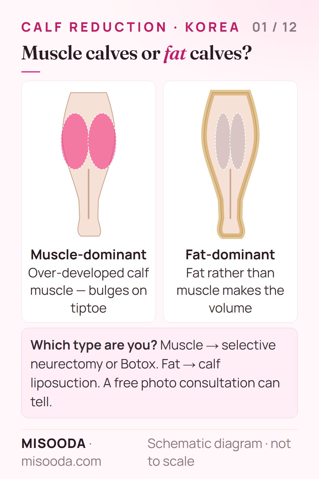 Calf reduction in Korea: muscle-dominant vs fat-dominant calves shown from behind — neurectomy or Botox for muscle, calf liposuction for fat