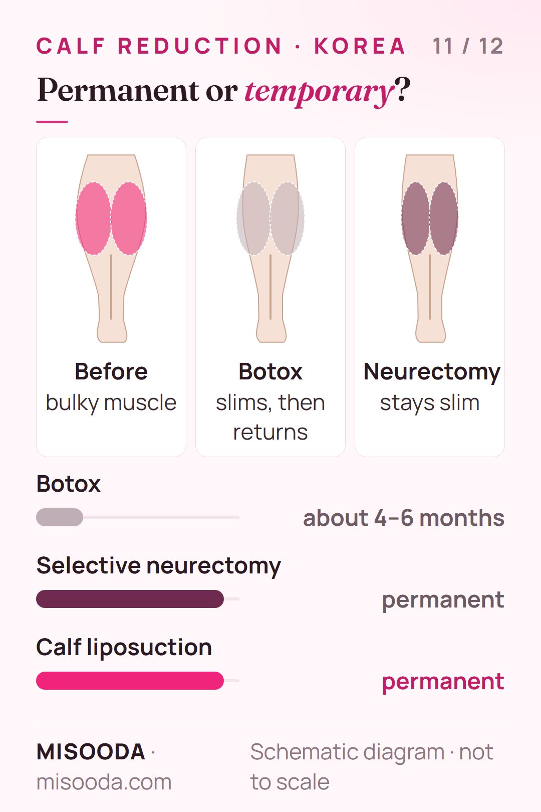 Calf reduction results: Botox lasts about 4–6 months, while selective neurectomy and muscle reduction are permanent and the muscle does not grow back