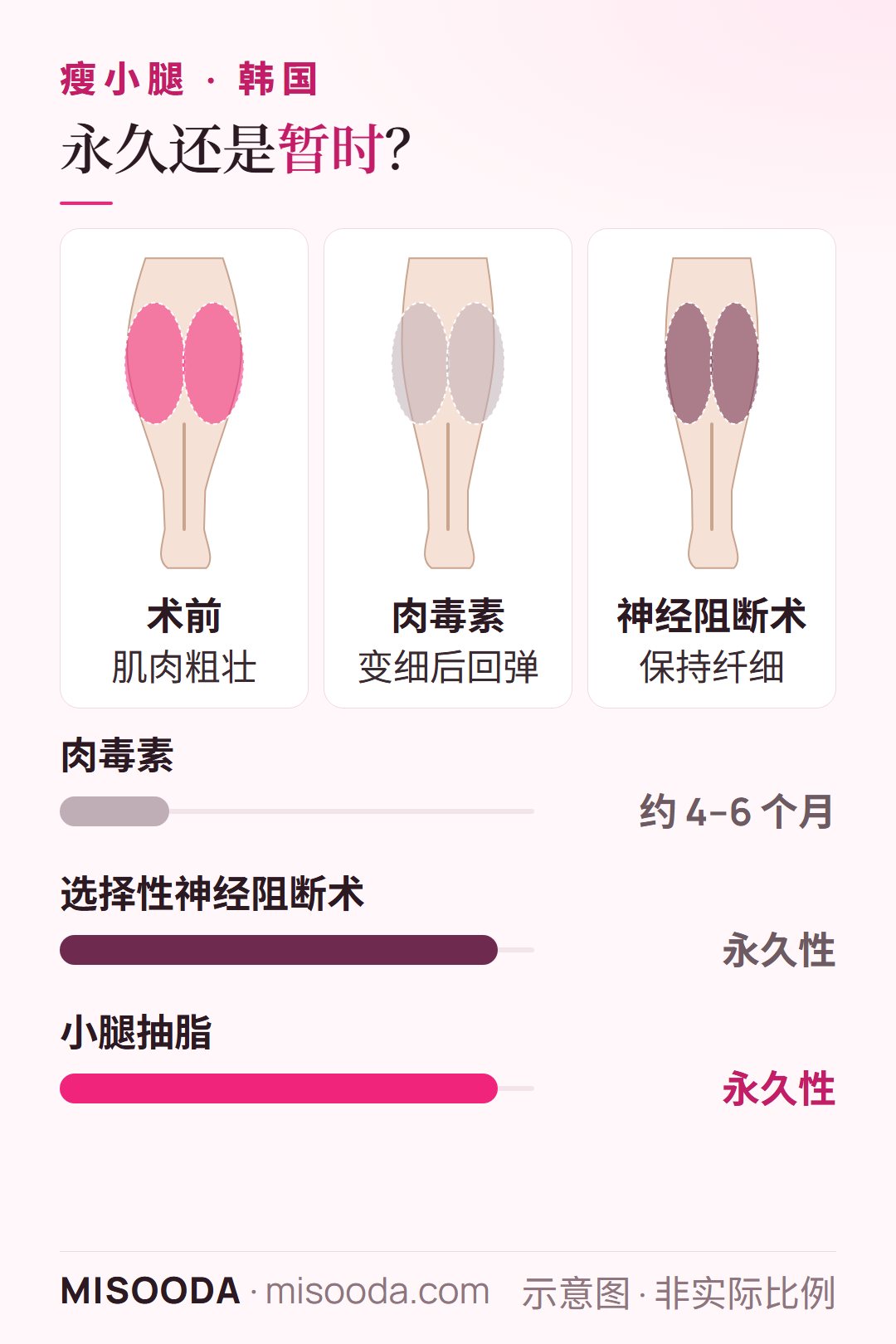 韩国 瘦小腿效果持久度:肉毒素约维持 4–6 个月,选择性神经阻断术与肌肉缩小术为永久性,肌肉不会再长回
