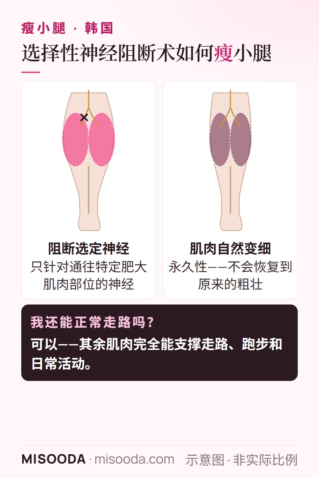 韩国 选择性神经阻断术瘦小腿:阻断通往肥大肌肉部位的神经,使肌肉永久变细;走路和跑步保持正常