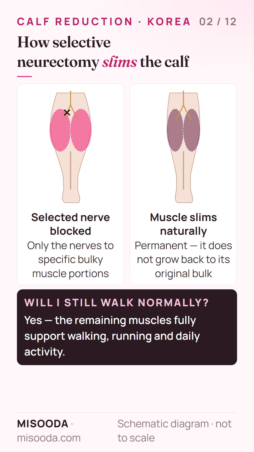 Selective neurectomy calf reduction: nerves to bulky muscle portions are blocked so the muscle slims permanently; walking and running stay normal