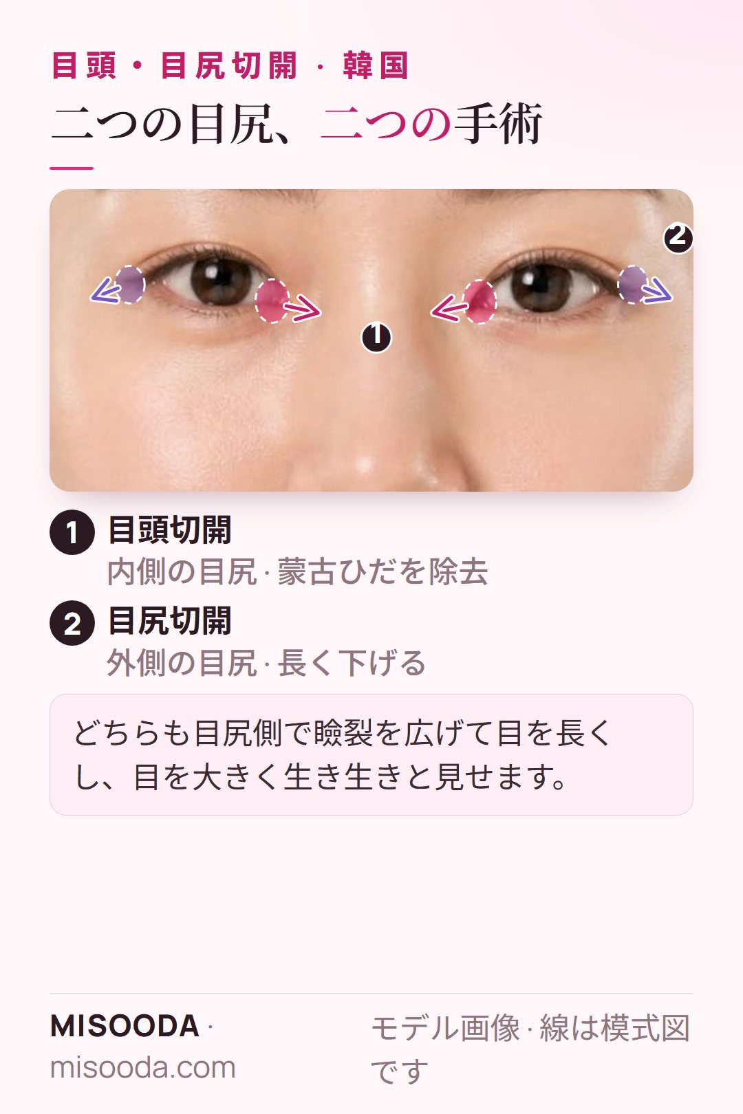 韓国 目頭切開・目尻切開の部位図:目頭切開は内側の蒙古ひだを開き、目尻切開は外側の目尻を長く下げます