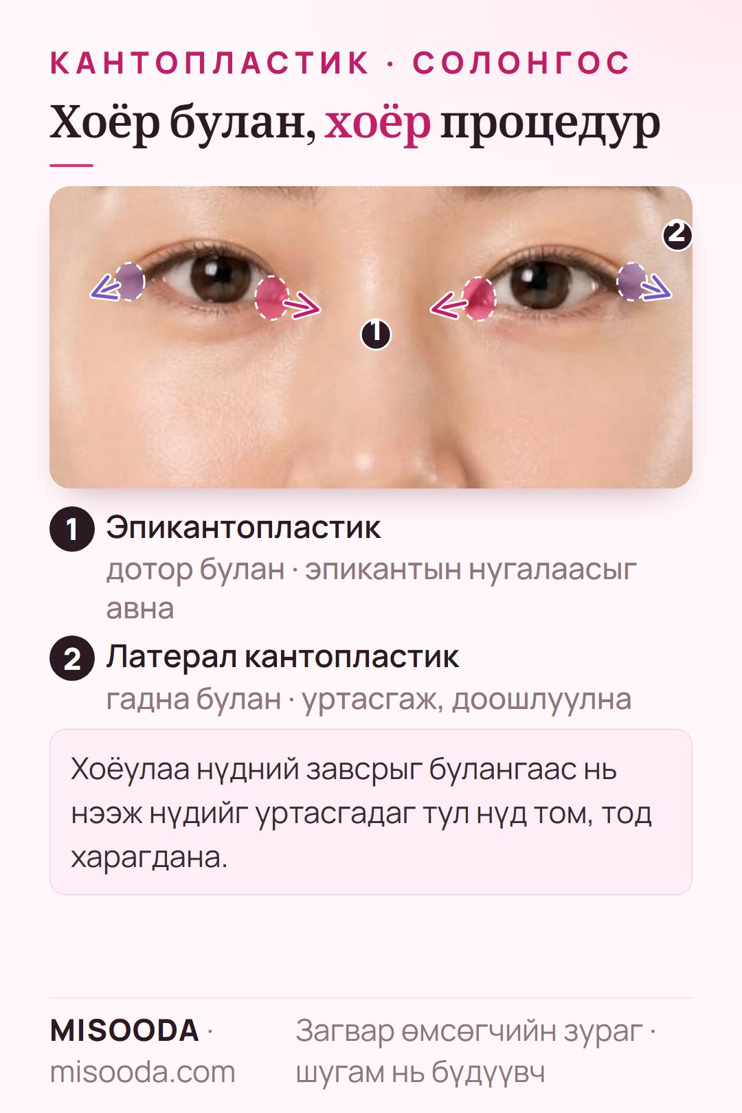 Хоёр нүдэн дээрх кантопластикийн зураглал: эпикантопластик нь дотор булангийн эпикантын нугалаасыг нээж, хажуугийн кантопластик гадна буланг уртасгаж, доошлуулна