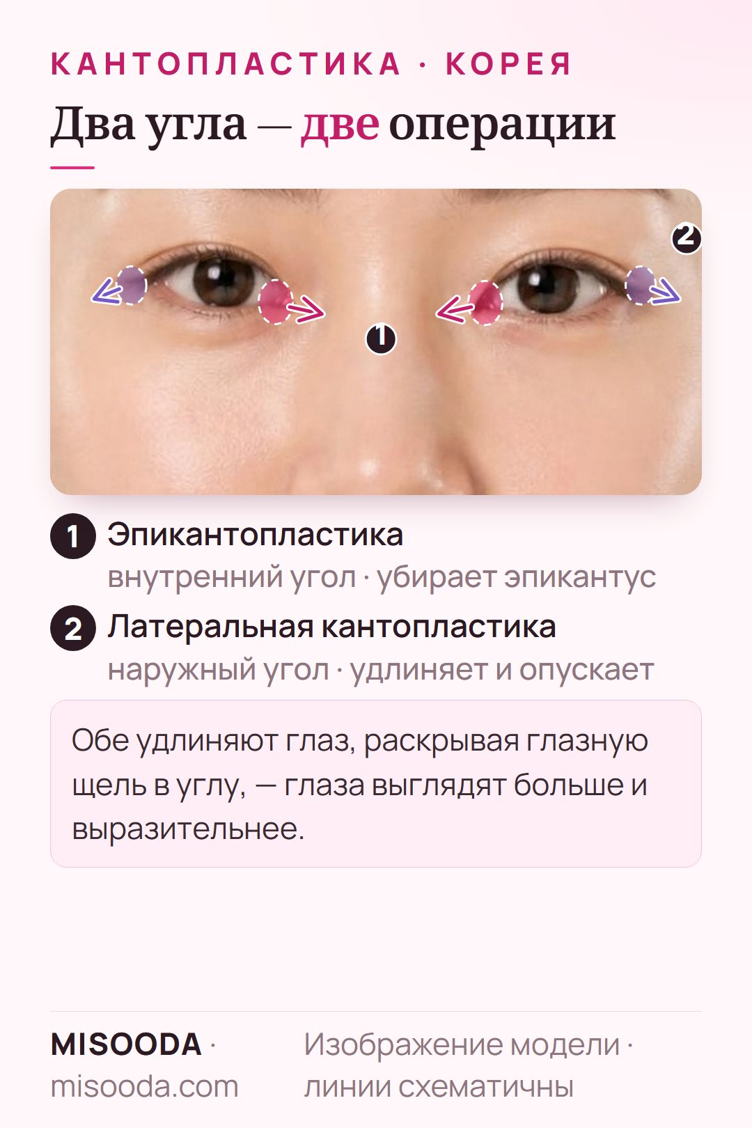 Кантопластика в Корее, схема на обоих глазах: эпикантопластика раскрывает эпикантус во внутреннем углу, латеральная кантопластика удлиняет и опускает наружный угол