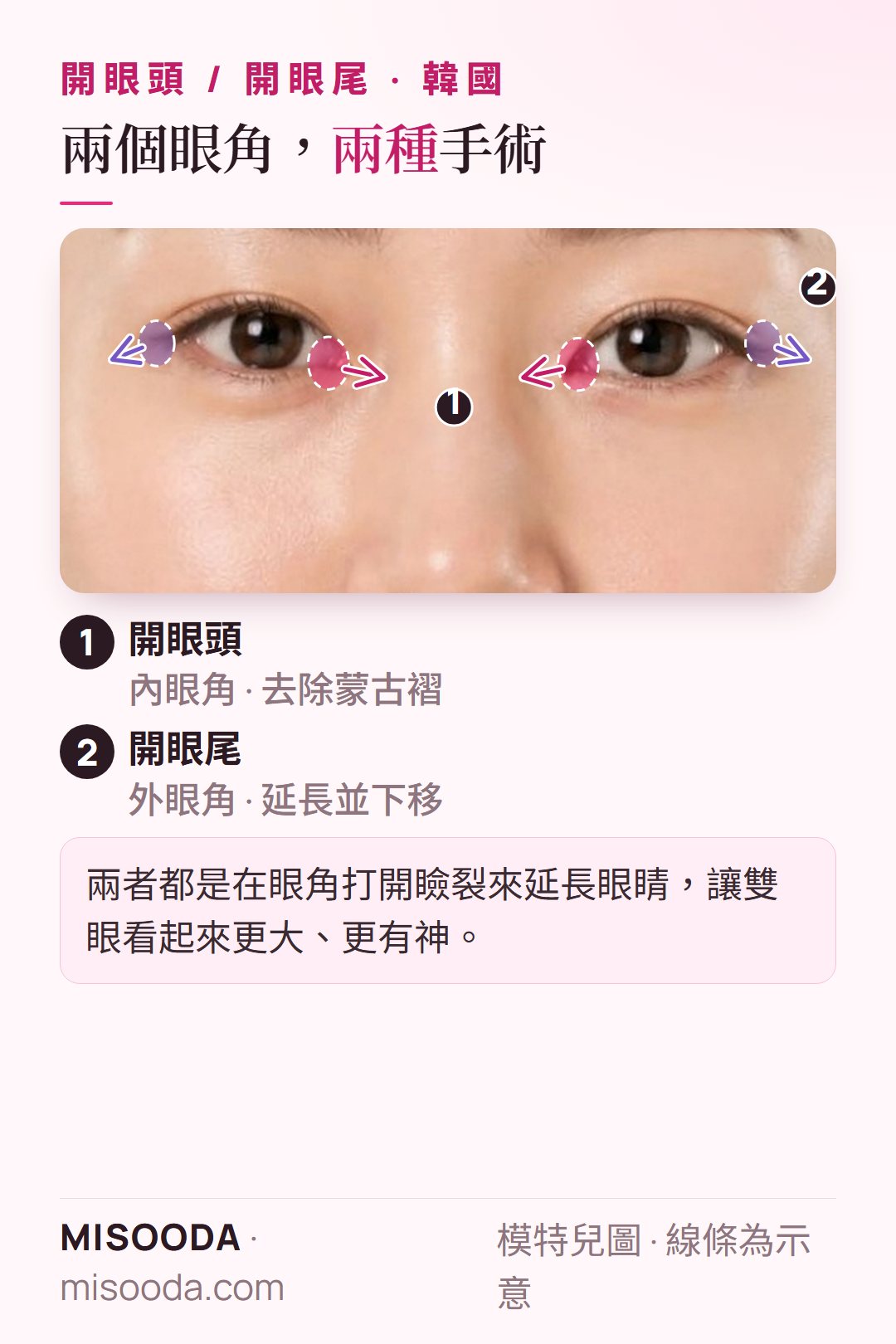 韓國 開眼頭與開眼尾雙眼位置示意圖:開眼頭打開內眼角的蒙古褶,開眼尾則延長並下移外眼角,讓眼睛看起來更大