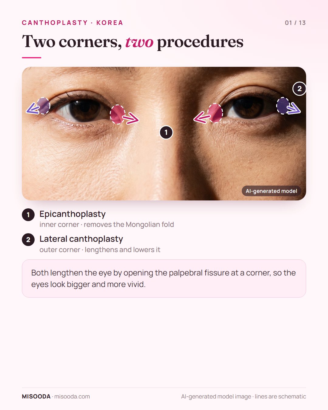 Canthoplasty map on both eyes: epicanthoplasty opens the inner corner Mongolian fold, lateral canthoplasty lengthens and lowers the outer corner