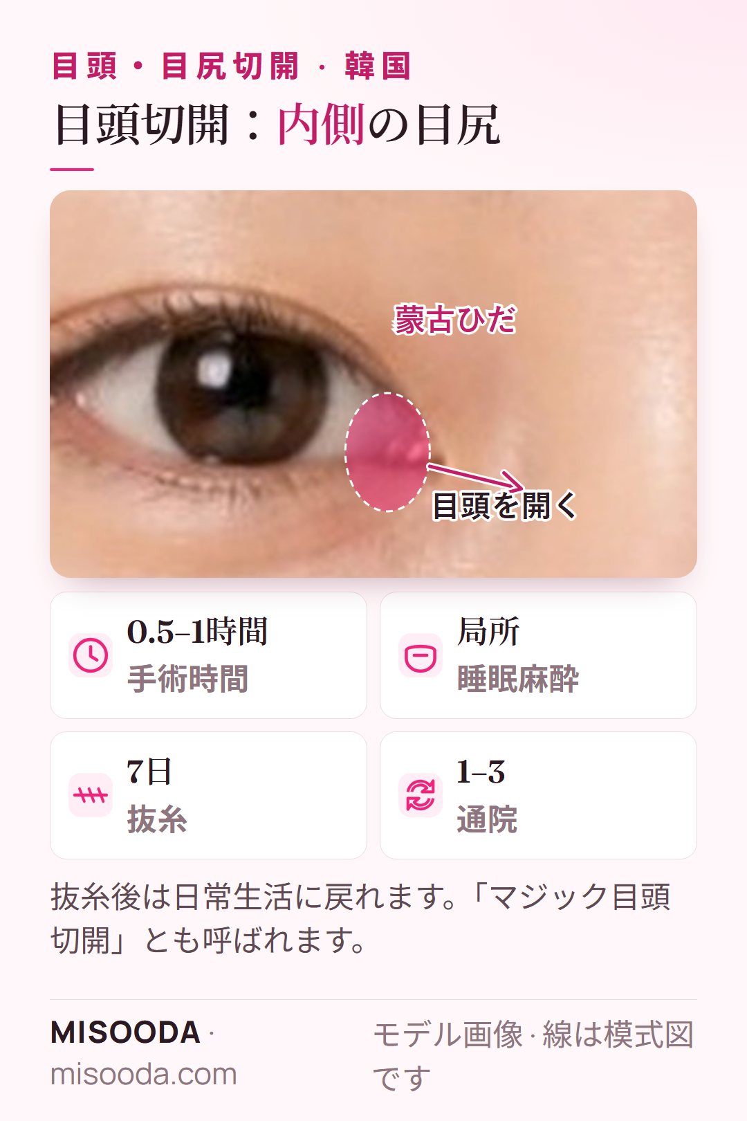 韓国 目頭切開:目頭の蒙古ひだ(内眼角贅皮)を除去して目を長くします。手術0.5–1時間、7日で抜糸