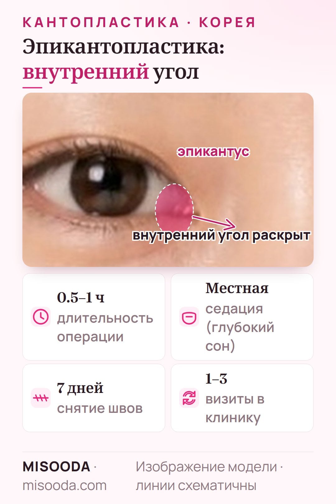 Эпикантопластика в Корее: эпикантус (монгольскую складку) во внутреннем углу глаза убирают, удлиняя глаз; 0.5–1 час, швы снимают на 7 день