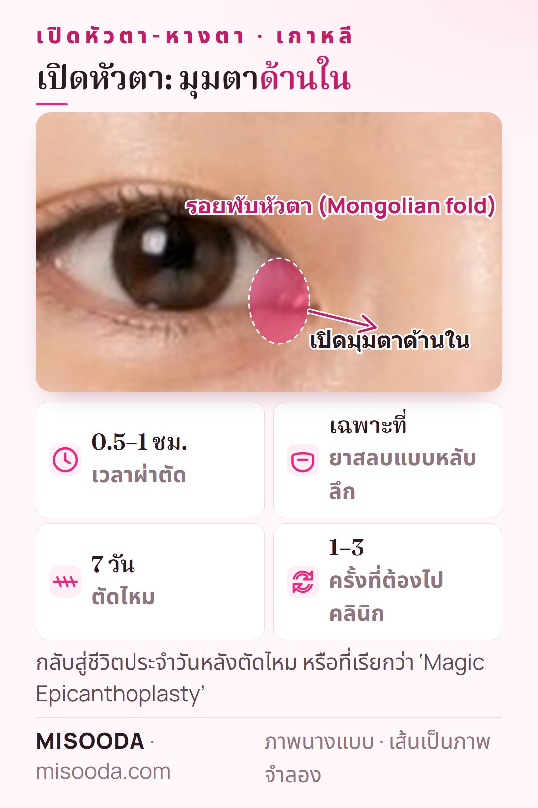 เปิดหัวตาในเกาหลี: ตัดรอยพับหัวตา (epicanthal fold) ที่มุมตาด้านในเพื่อยืดตา ใช้เวลา 0.5–1 ชั่วโมง ตัดไหมที่ 7 วัน
