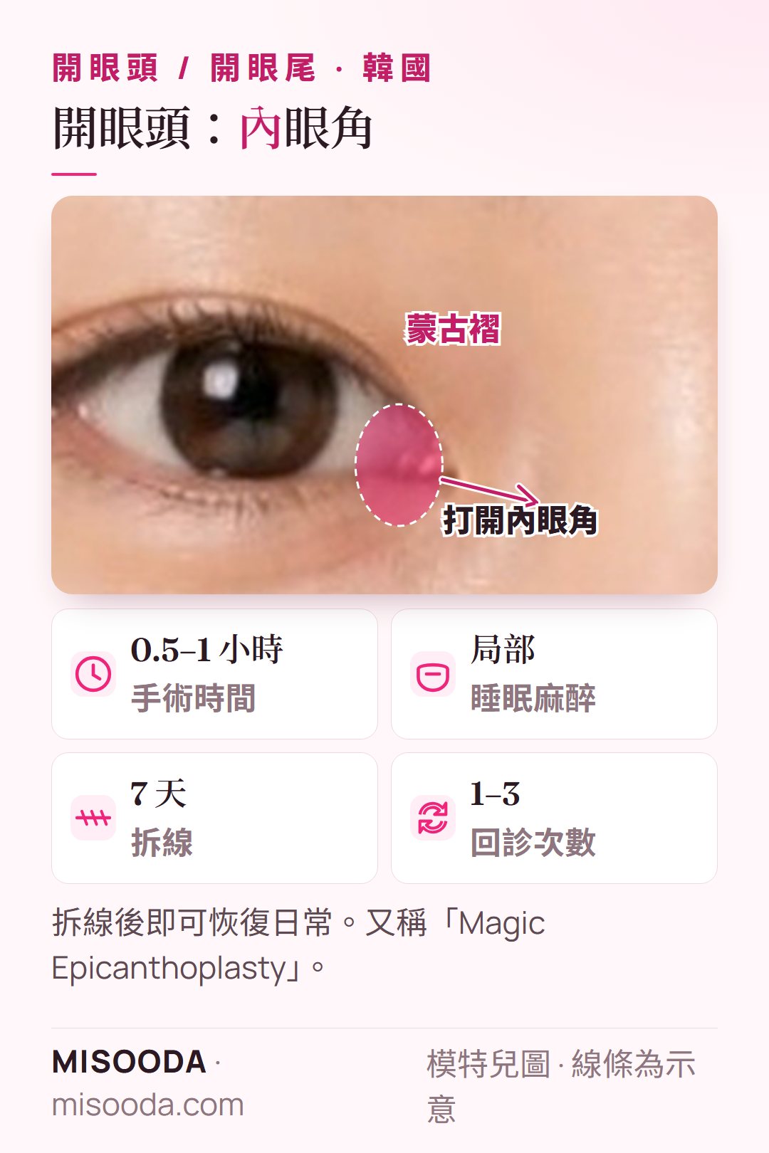 韓國 開眼頭:去除內眼角的蒙古褶(內眥贅皮)以延長眼睛;手術 0.5–1 小時,第 7 天拆線