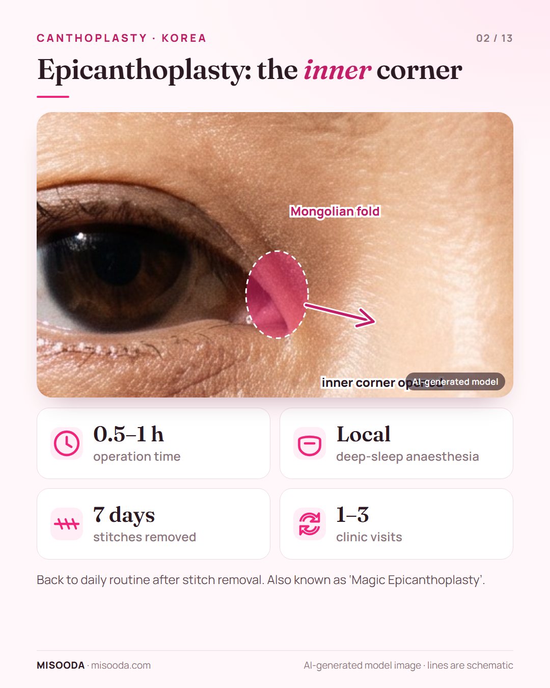 Epicanthoplasty in Korea: the Mongolian (epicanthal) fold at the inner eye corner is removed to lengthen the eye; 0.5–1 hour, stitches out at 7 days