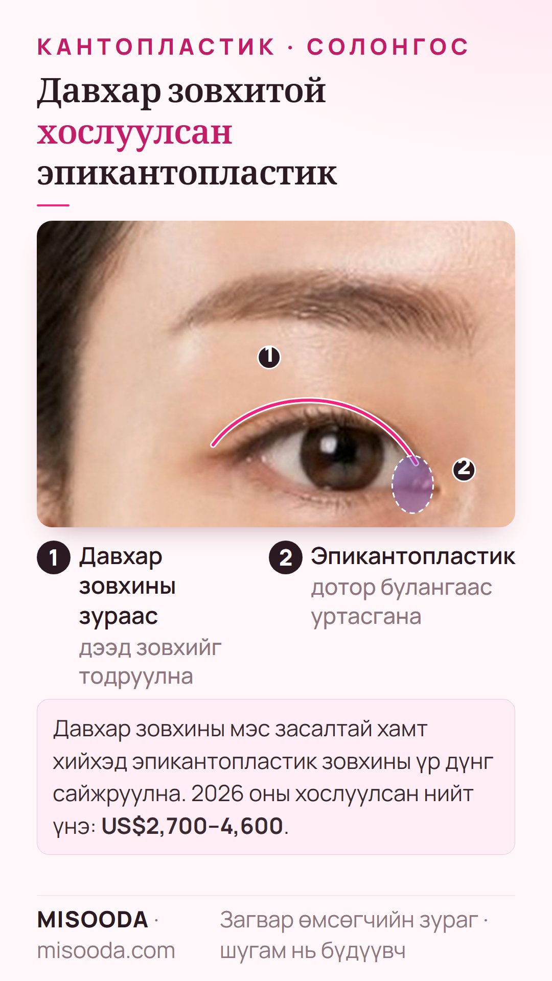 Нэг нүдэн дээр давхар зовхины мэс засалтай хослуулсан эпикантопластик: зовхины зураас дээр дотор буланг нээх; Солонгост 2026 онд хослуулсан үнэ US$2,700–4,600